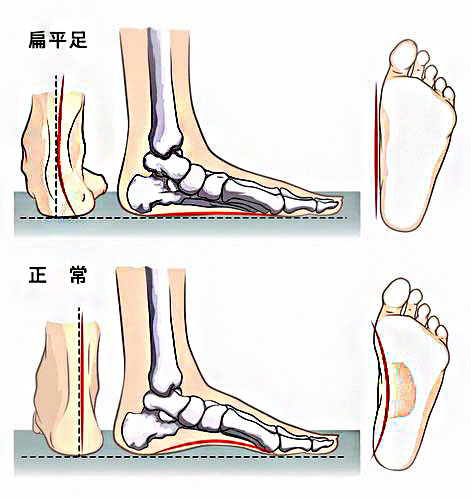 扁平足