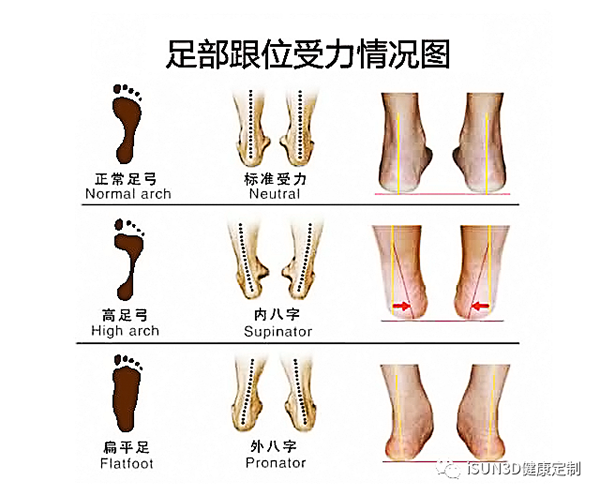 足型研究所——扁平足和足外翻案例详解
