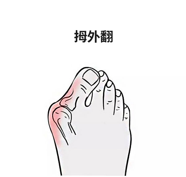 拇外翻