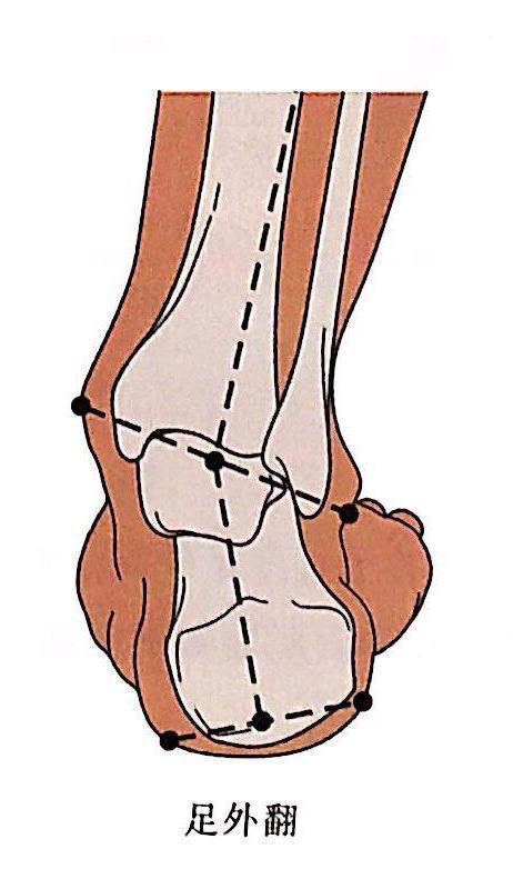 足外翻