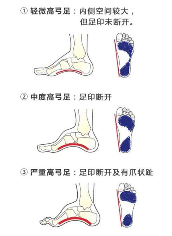 高弓足程度图-双脚打湿测试